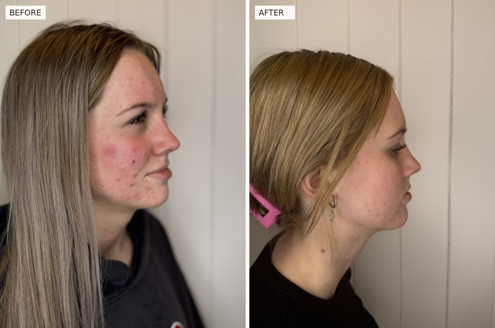 Clear Skin Protocol, right side