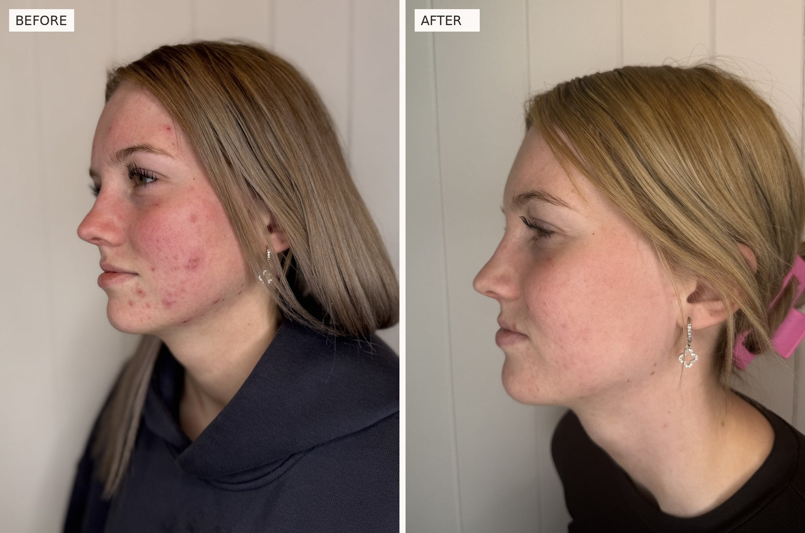 Clear Skin Protocol, left side